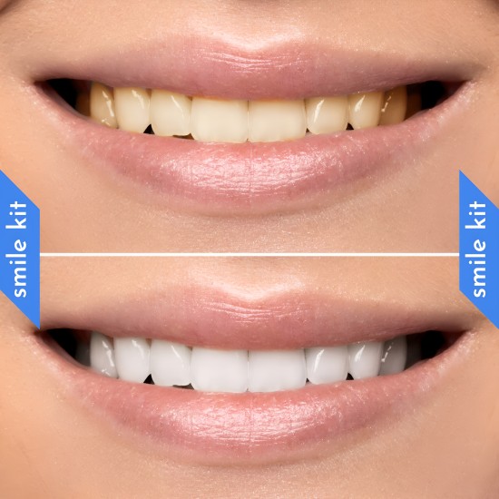 Teeth Whitening Paste
